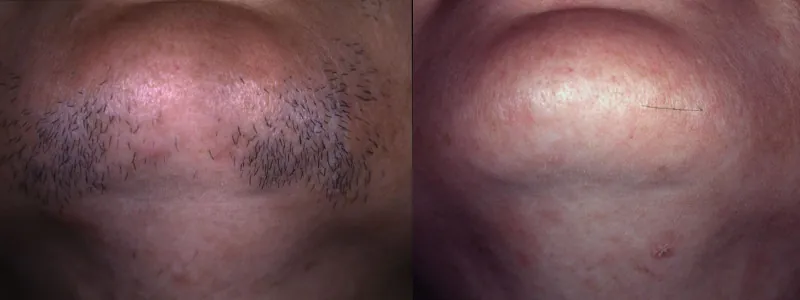laserowe usuwanie włosów- zarost twarzy