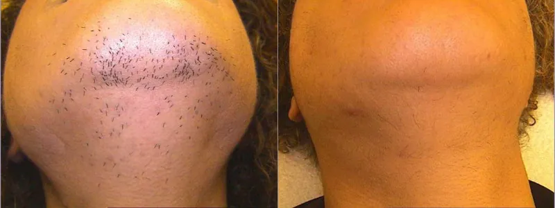 laserowe usuwanie owłosienia - broda